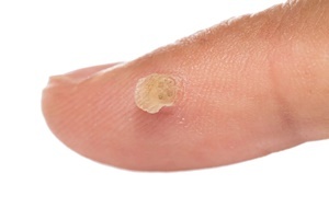 Bir siğil Skincell Pro, etkili bir şekilde savaşır bir deri hastalığıdır